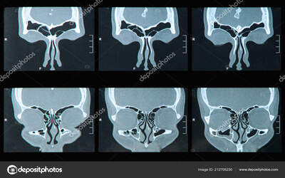 Как проводится МРТ пазух носа и что показывает