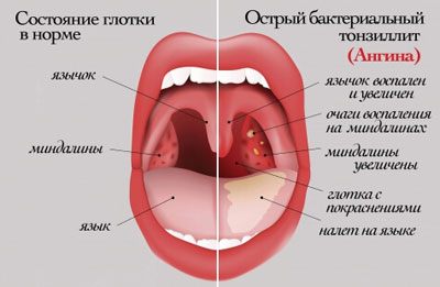 Симптомы и лечение острого тонзиллита у ребенка