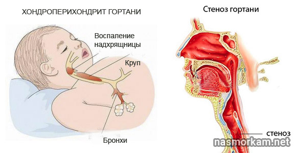 Чем лечить боль в горле при глотании