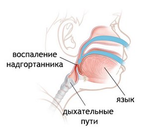 Воспаление гортани, надгортанника, глотки