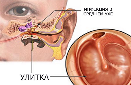 Что такое отит или воспаление уха