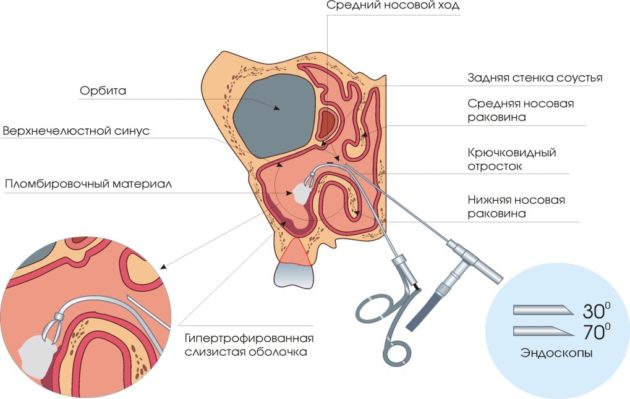 Эндоскопическое удаление полипов