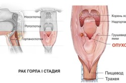 Пальпация гортани и шеи