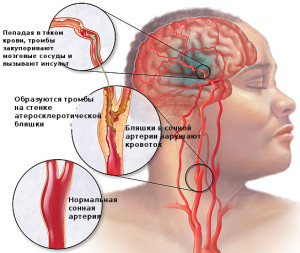 При каких заболеваниях давит на уши изнутри