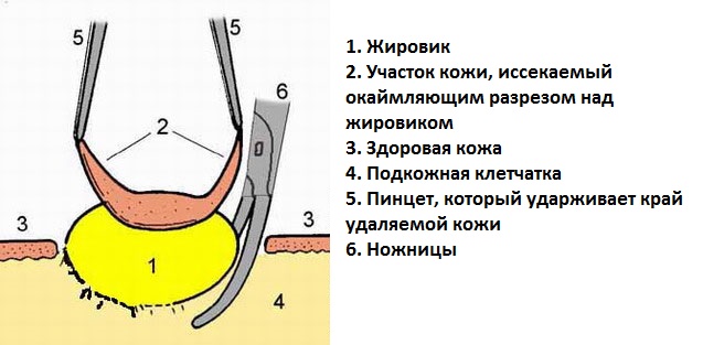 Причины появления жировика за ухом