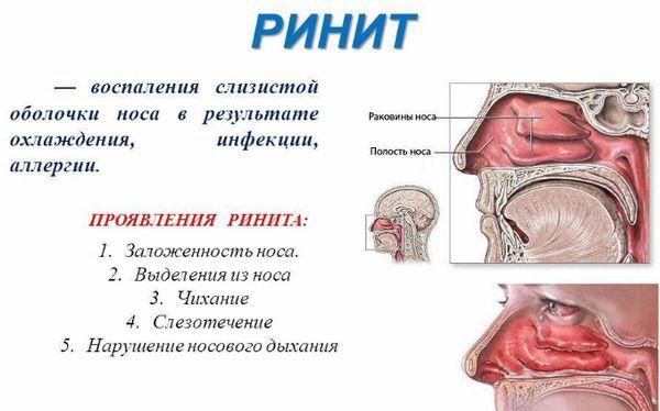 Самые эффективные средства от храпа в аптеках