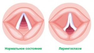 Спазмы горла и панические атаки