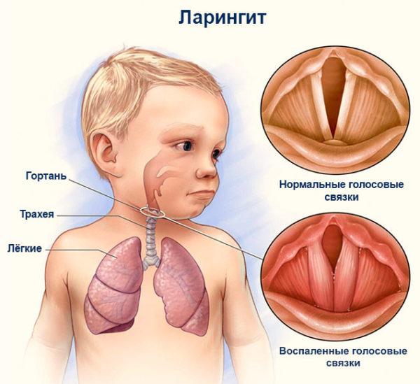 Ларингит заразный или нет