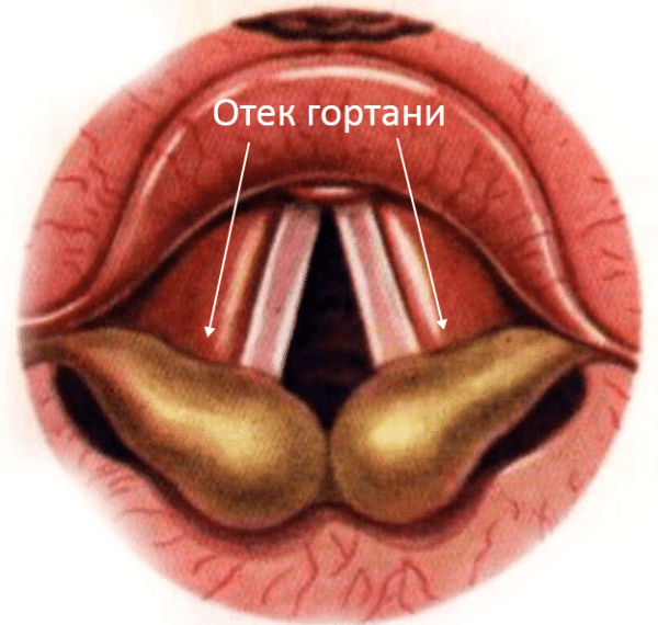 Симптомы, лечение и причины отека гортани у взрослых, оказание первой помощи