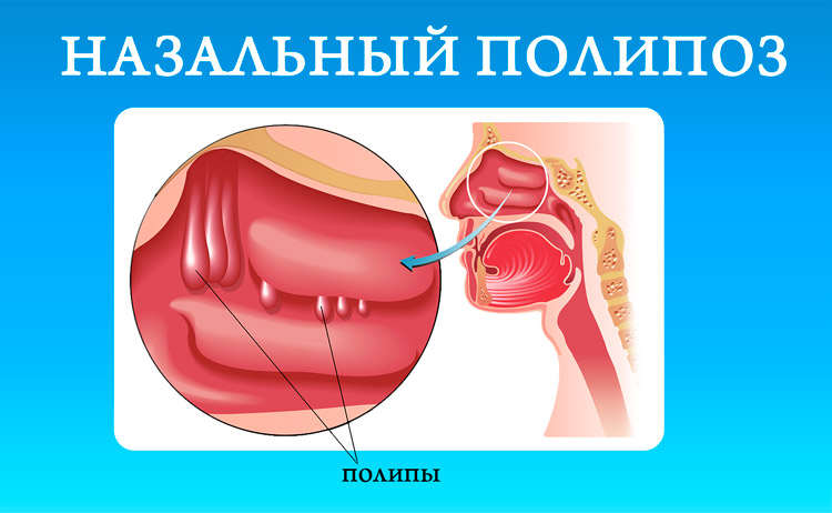 Как победить неприятный запах в носу