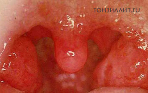 Как проявляется и лечится катаральная ангина у детей