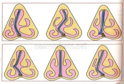 Септопластика носовой перегородки показания и противопоказания к проведению операции