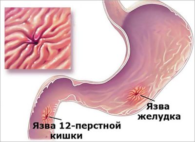 Рецепты из лука от кашля и насморка на все случаи жизни