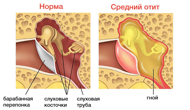 Возможные осложнения после гайморита