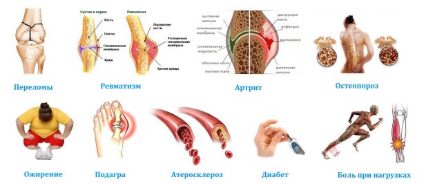 Антибиотик азитромицин при ангине