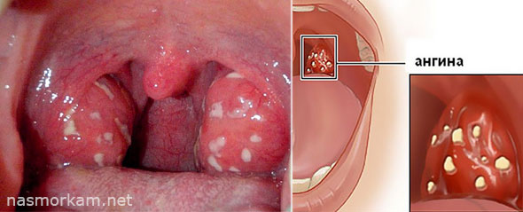 Болит горло слева при глотании и кашле