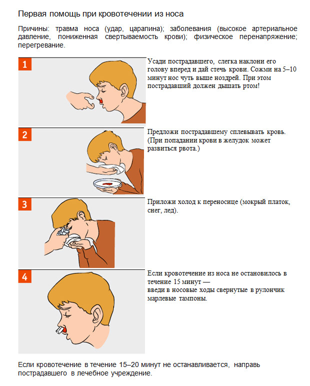 Неотложная помощь при носовых кровотечениях