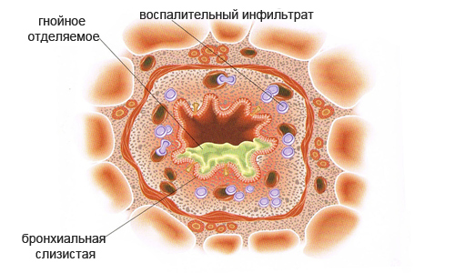 Бронхит у взрослых