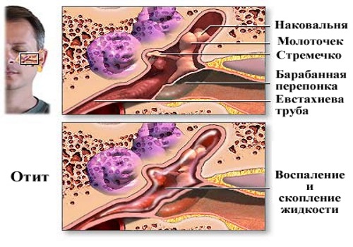 Из уха течет желтая жидкость о чем говорит симптом