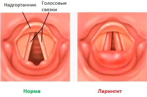 Пропал голос в чем причина и как лечить в домашних условиях