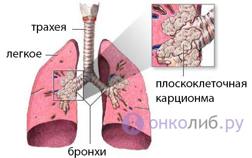 Опухоли трахеи. Симптомы и лечение рака трахеи