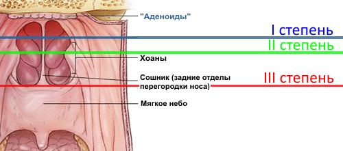 Три степени аденоидита у детей