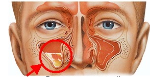 Какие признаки и как лечить катаральный синусит