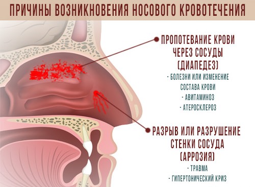 Причины носового кровотечения