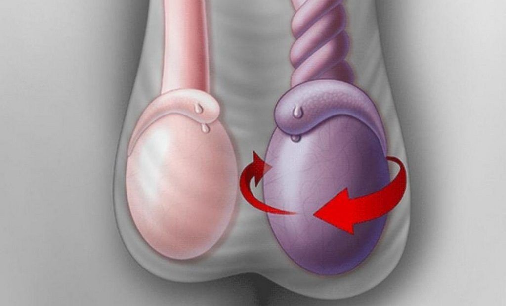 Что такое перекрут яичка у мужчин