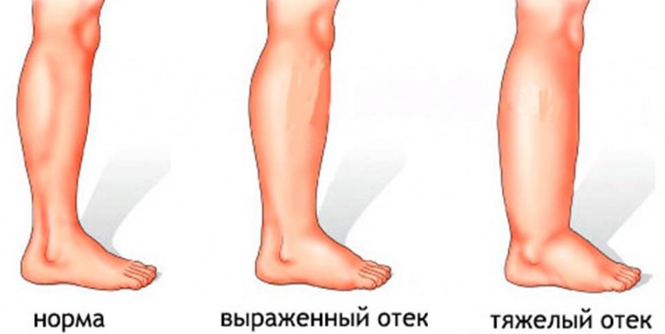 Лимфостаз: Понимание, причины и лечение