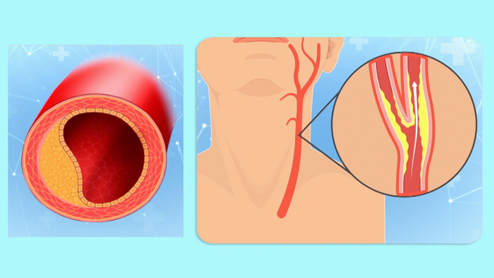 Что делать, если у вас обнаружили атеросклероз