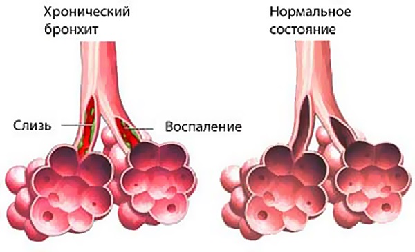 Чем и как лечить хронический бронхит