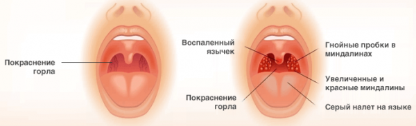 Основные признаки ангины