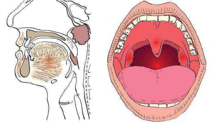 Способы лечения и осложнения при кисте миндалины