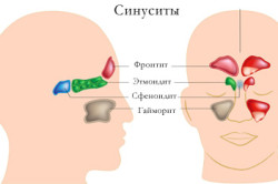 Какие признаки и как лечить катаральный синусит