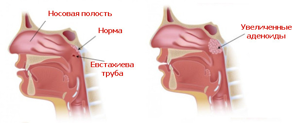 Заложенность носа у ребенка. Особенности лечения