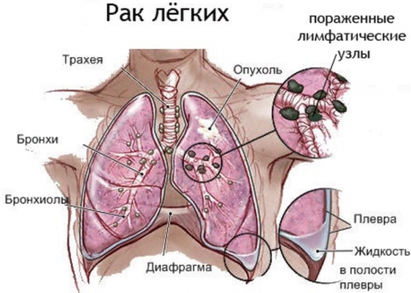 Мокрота курильщика и после отказа от курения. Сколько отходит и как избавиться