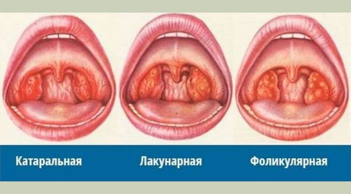 Процедура удаления миндалин при хроническом тонзиллите