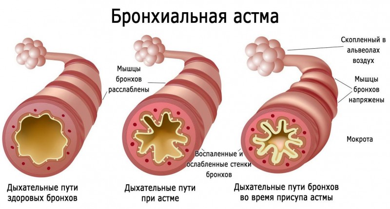 Свистящее дыхание и его лечение