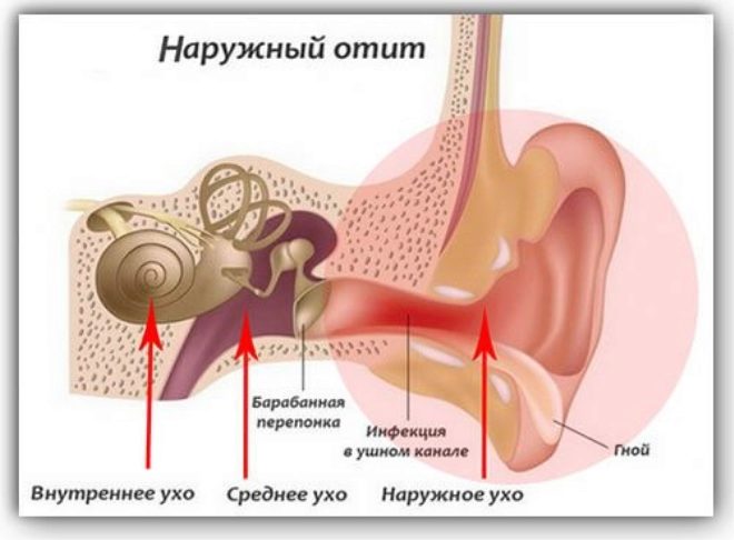 Лечение отита у детей основные виды отита и методы лечения