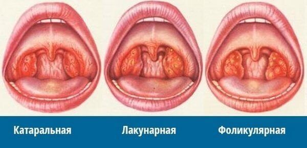 Лечение ангины у детей по методике доктора Комаровского