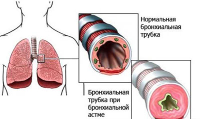 Лечение и профилактика воспаления бронхов