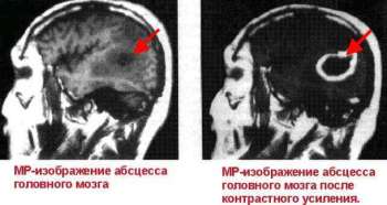 Симптомы и лечение двухстороннего синусита