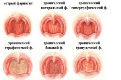 Гранулезный фарингит причины и лечение