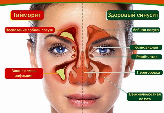 Определение и диагностика гайморита без снимка в домашних условиях