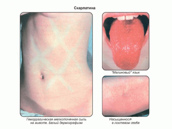 Скарлатина у ребёнка