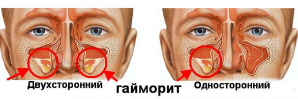 Применение Флуимуцила для ингаляций