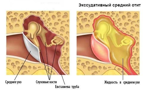 Экссудативный средний отит