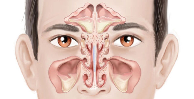 Возможные осложнения после гайморита