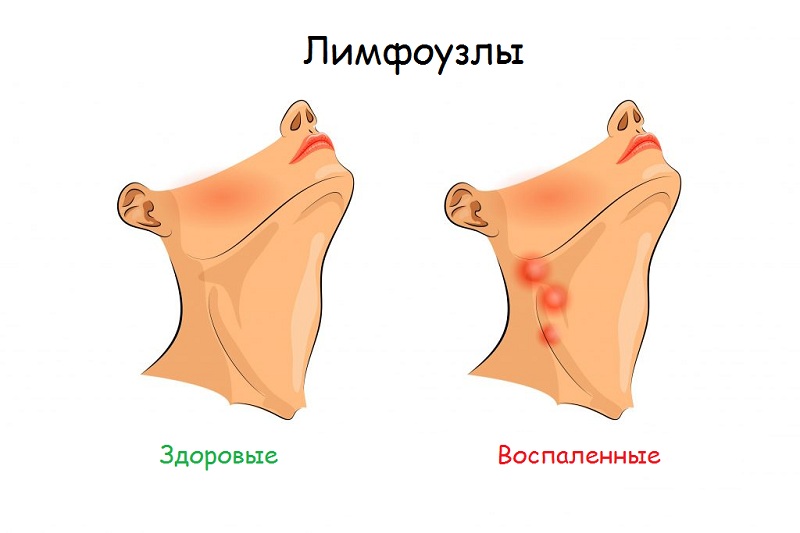 Причины и лечение воспаления лимфоузлов за ухом